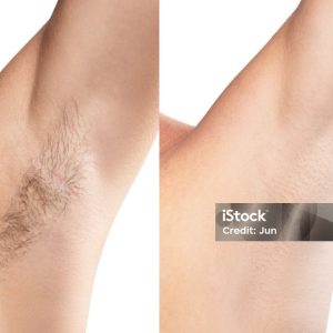 Full Body Diodo Laser Hair Removal